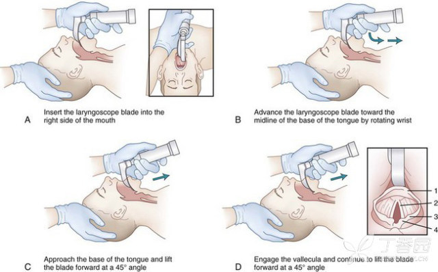 endotracheal tube intubation