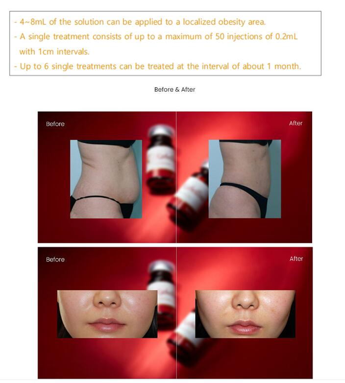 Fat Dissolving Injection