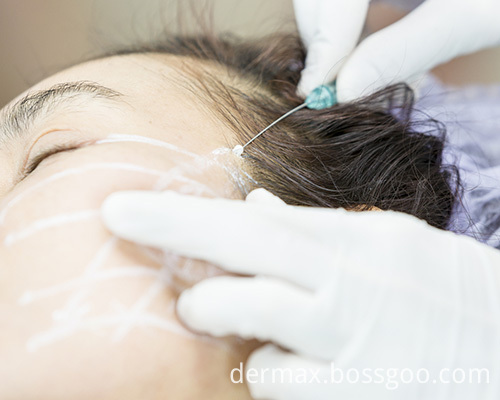 pdo face lifting