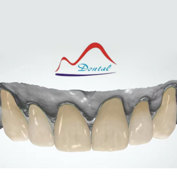 CAD/CAM Porcelain Veneer Design