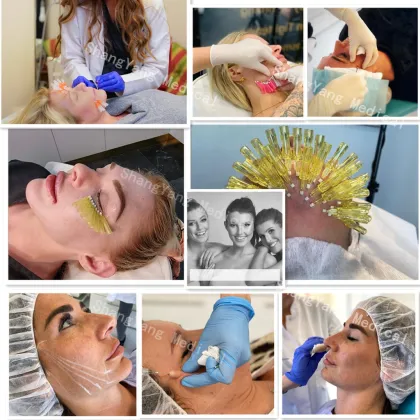 Well-known pdo thread Korea minerva absorbable and needle skin tightening lifting,Remove Wrinkles