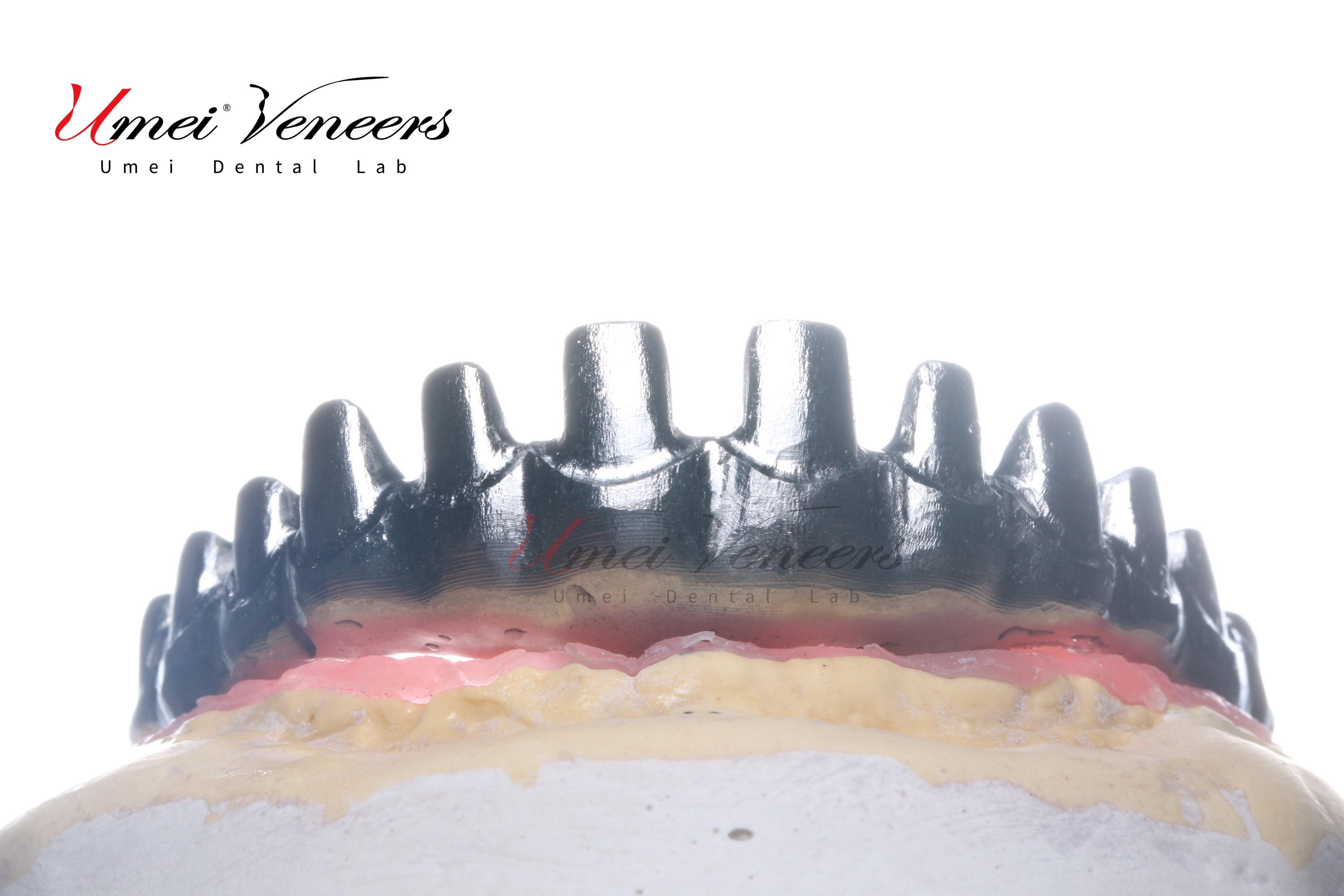 Full Arch Zirconia Implant Bridge