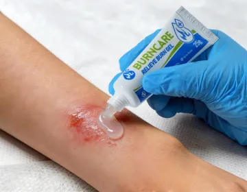 Burn Gel Dressing