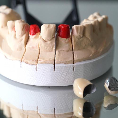 3/4 Porcelain Metal Crown