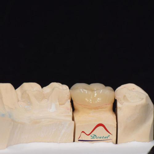 Posterior IPS e.max Press Prosthesis