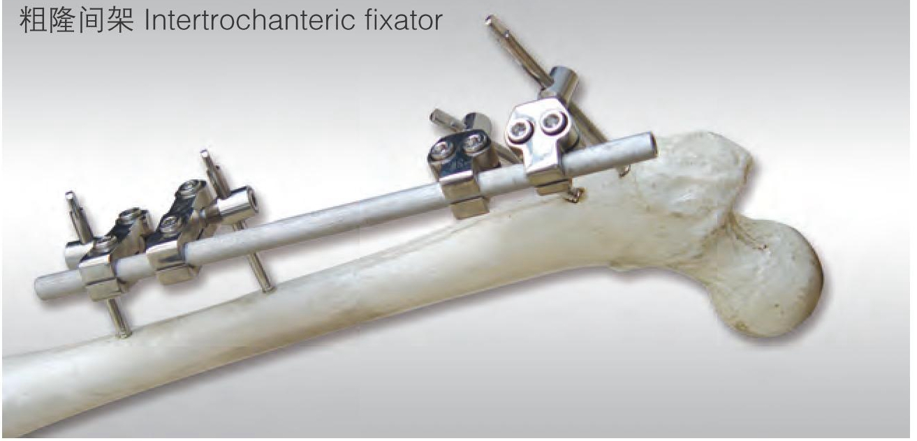 intertrochanteric fixator