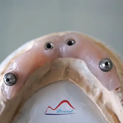 All-On-Four Dental Implant Restoration