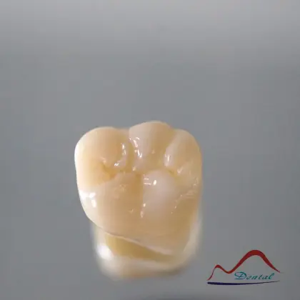 Molar Full Zirconium Restoration