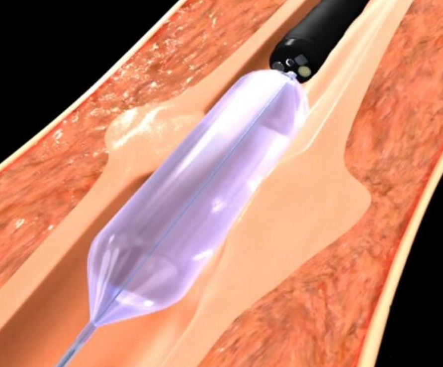 Specifications 3-stage Dilation Balloon Catheter-Jiangsu Changmei