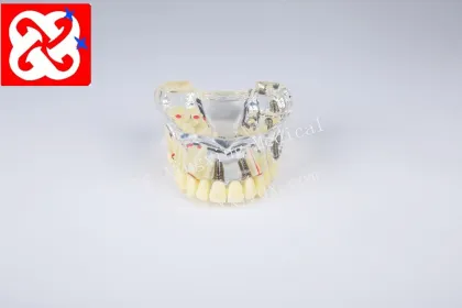 Dental Model Upper Half: Implant and Restoration