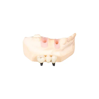 Custom Abutment with Two Brand New Screws