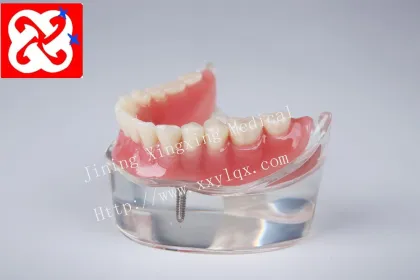 Mandibular Overdenture Restoration with 2 Implants
