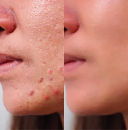 OEM anti acne whitening serum