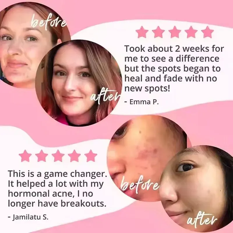 Vegan Acne Capsule for Oily Skin