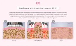 New Arrival 40K Cavitation 80K Vacuum RF Laser Pads Lipo Slimming fat burning 9 in 1 cavitation machine