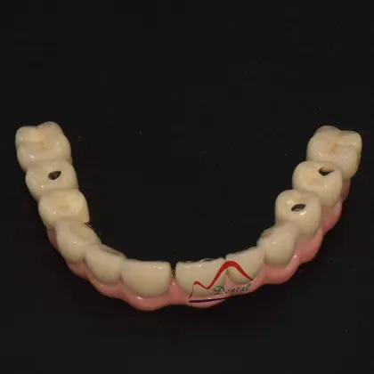 Malo Implant Bridge Restoration