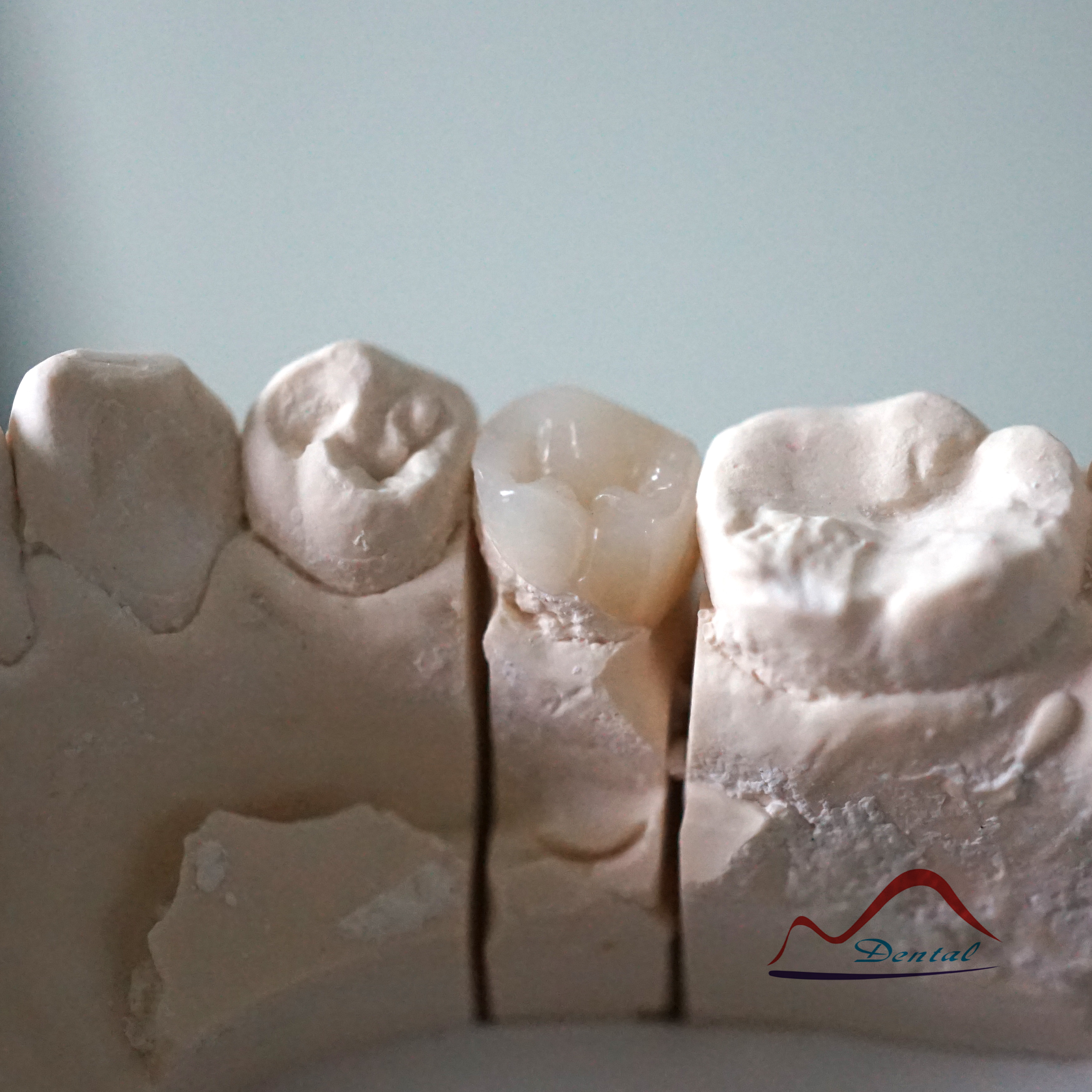 Dental Composite Resin Onlay
