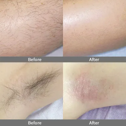 Diode Laser Hair Removal Equipment: Alex Nd and Future Models