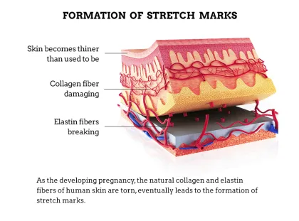 OMYLADY Stretch Marks & Scar Removal Cream