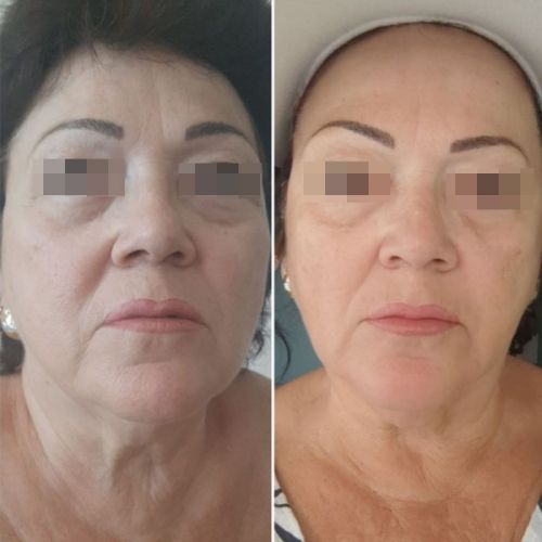 Advance Clinical Facial Wrinkle Removal Treatment Filler
