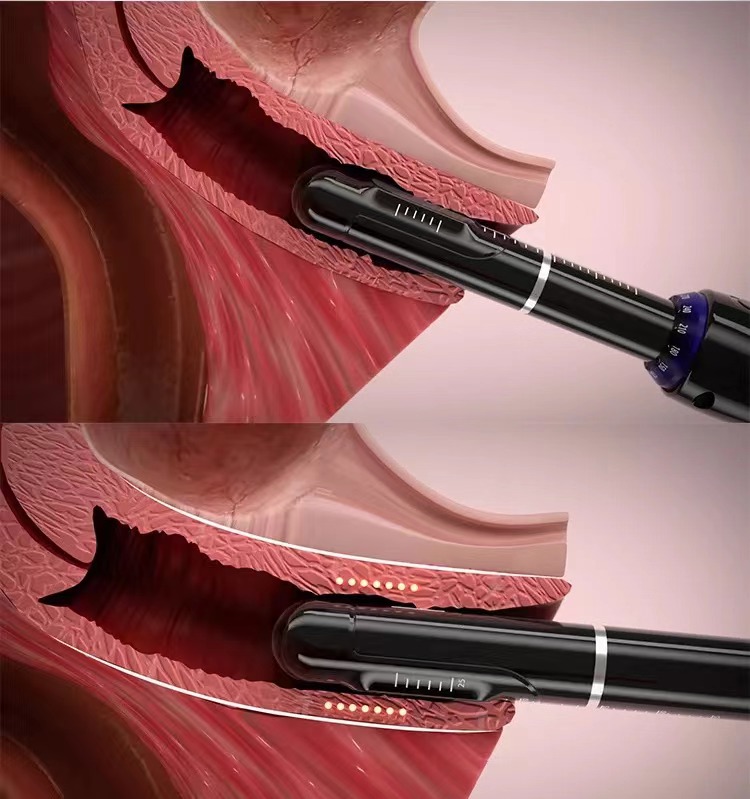 7D Hifu Machine