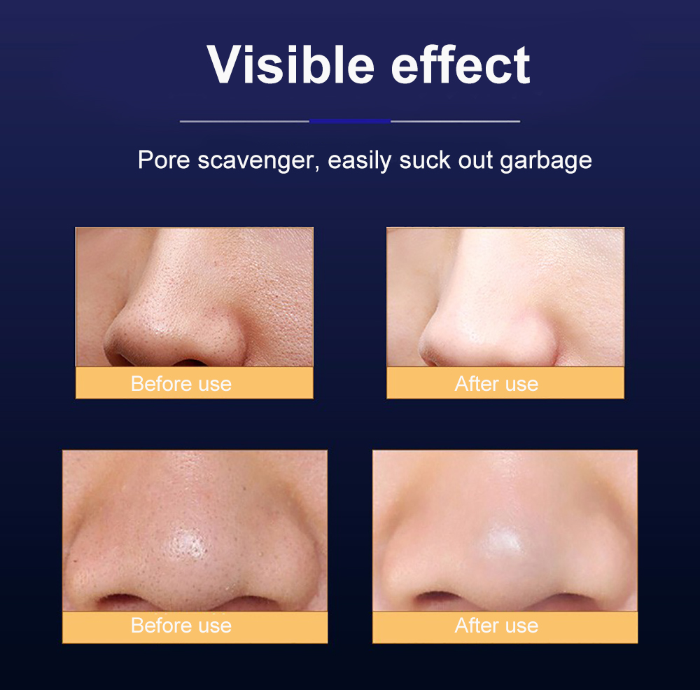 Electric Blackhead Remover Water Cycle Vacuum Acne Spots Pore Pimple