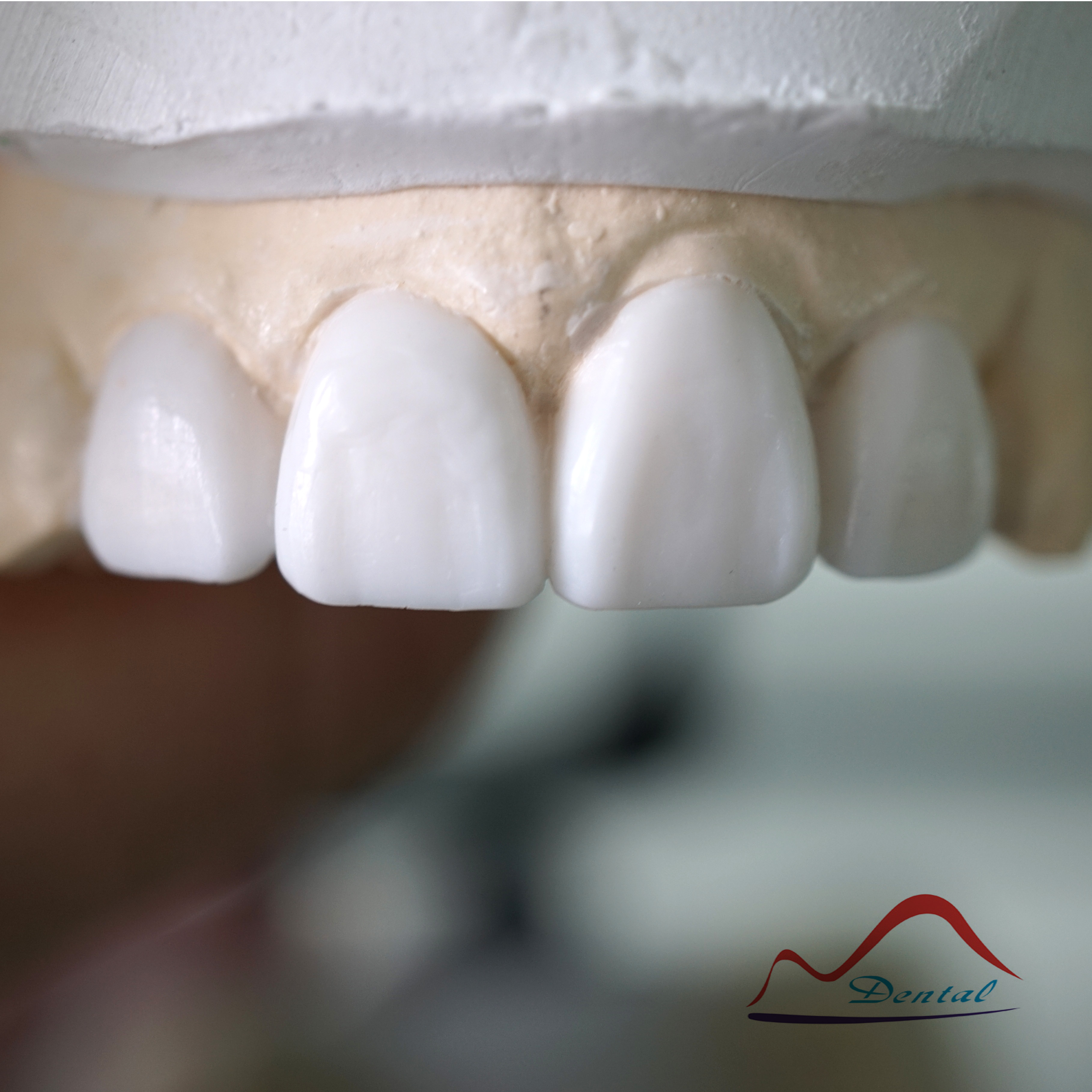 Dental Diagnostic Wax-up