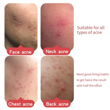 MINGRENTANG Effects Acne Cream Tea tree Essence