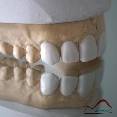 Dental Diagnostic Wax Up