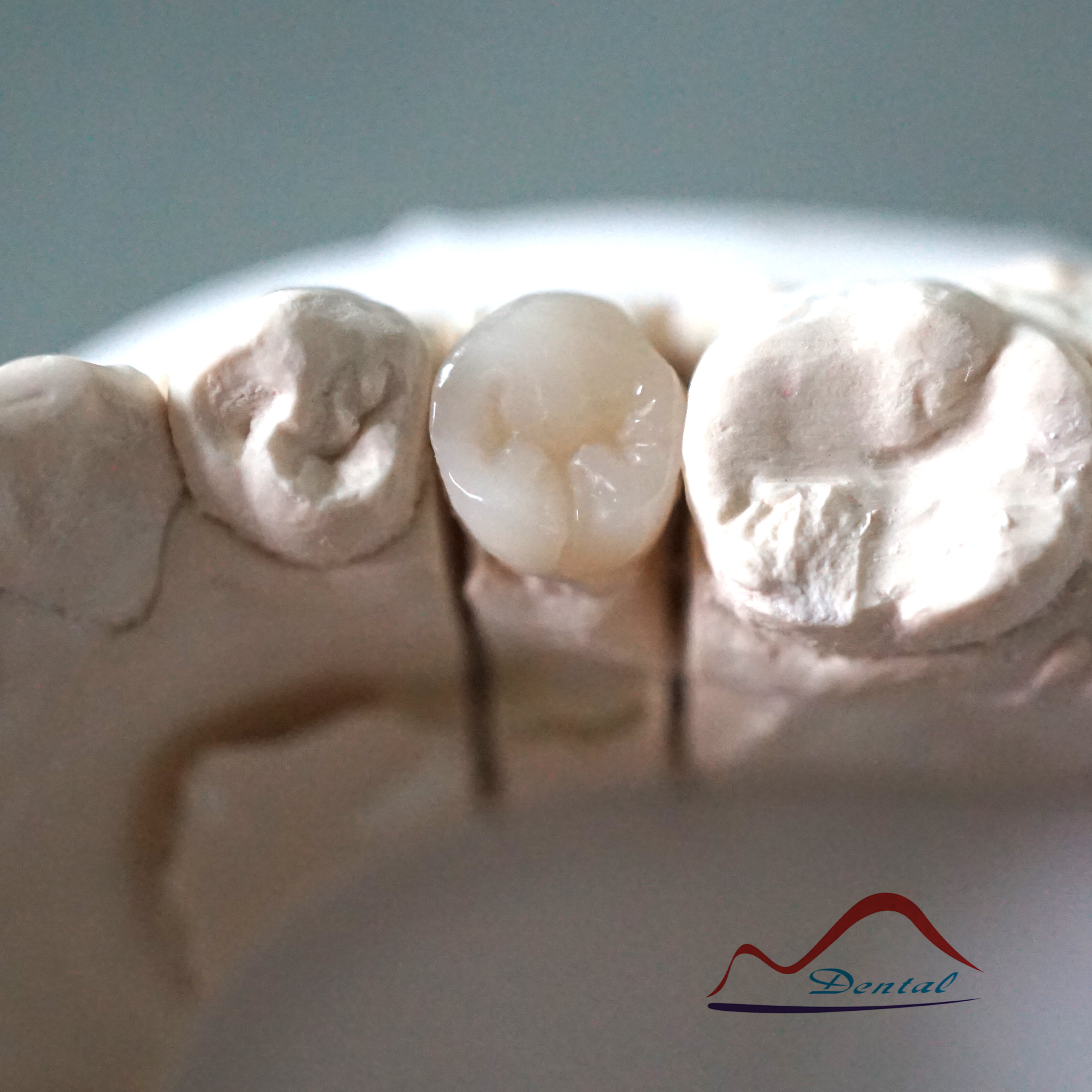 Dental Composite Resin