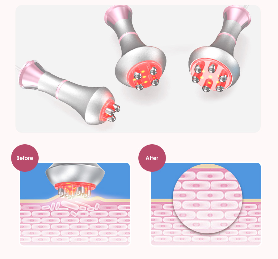 rf skin tightening