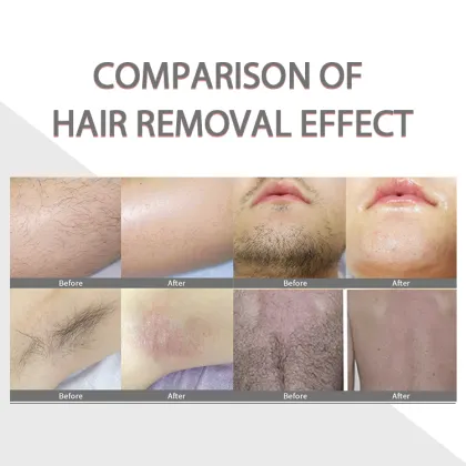 Laser Harmony Xl Pro: Diode Laser Titanium Hair Removal Epilator