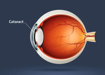 viscoelastic solution ophthalmic surgery