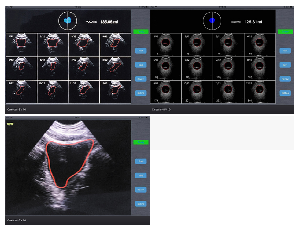 Bladder Ultrasound Device