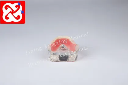 Mandibular Overdenture Implant Teeth Model with 4 Implants