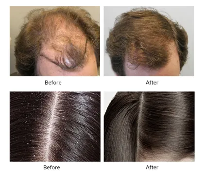 Japanese Anti-Hair Loss Shampoo Set for Hair Growth