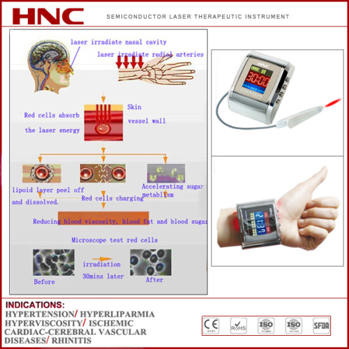 650nm Laser Infrared Therapy for Diabetes Instrument