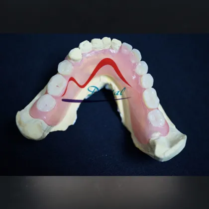 Mega Valplast Flexible Denture