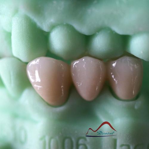 Zirconia Bridge On 3D Printing Model