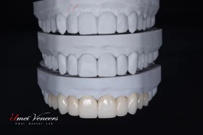 Strong zirconium oxide veneers