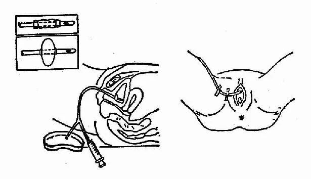 Intermittent catheter (2)