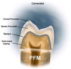 High Intensity Porcelain Fused To Metal Of Dental Lab With Custom Made Contour