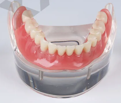 Mandibular Overdenture Restoration with 2 Implants