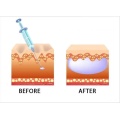 Derma véu escultura trap hyaron hyaron Placentex Restyla ne Rejuran Forte Colágeno Mesoterapia Solução SERUA DE SERU