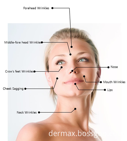 pdo-thread-treatment-areas