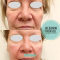 Fine Lines Removal Dermal Filler For Sagging Upper Eyelids