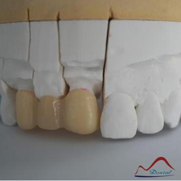 CAD/CAM Milling Zirconia Coping Bridge