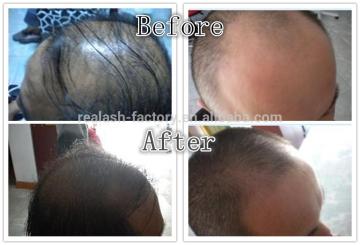 Thick hair growth spray both for men and women