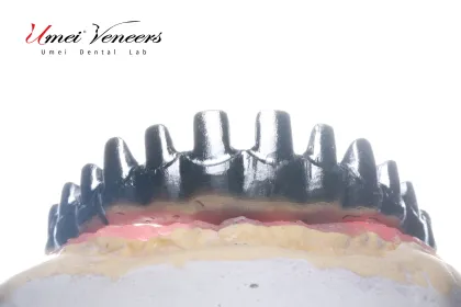 Biocompatible Titanium Marlow Bridge