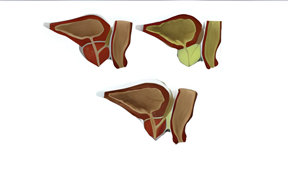 Prostate Pathological Model( medical education)